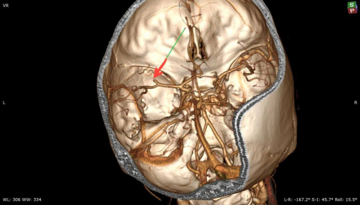 Инсульт на рабочем месте из-за стресса получила 35-летняя жительница Воронежа
