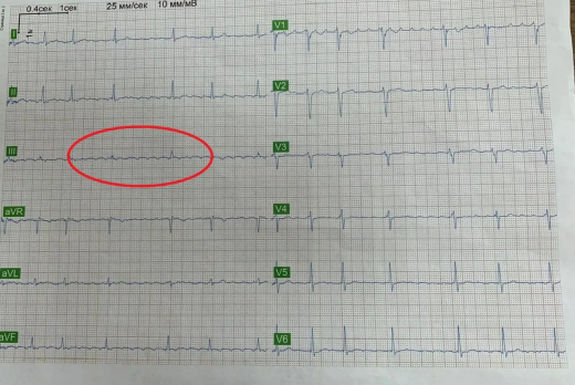 Жена заметила аритмию у воронежца, прижавшись к груди