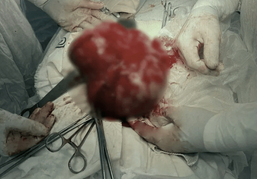 Жительница Воронежа 15 лет не решалась вырезать гигантскую опухоль в матке