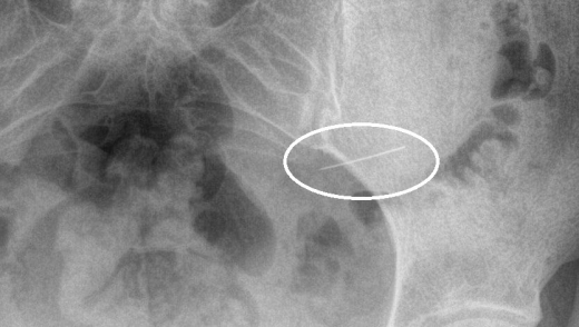 Жительница Красногорска случайно проглотила швейную иглу