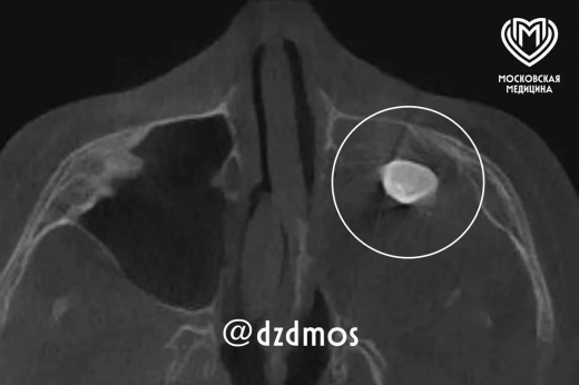 У 15-летнего москвича нашли зуб в носу