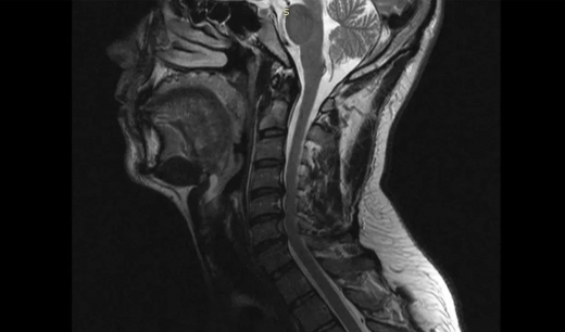 Уникальная операция воронежских нейрохирургов вернула мужчине свободу движений рук
