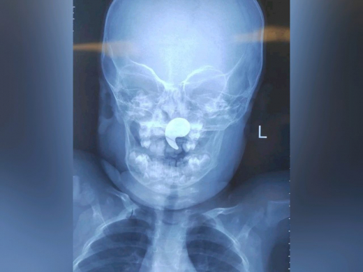 Из-за магнита в носу полуторагодовалая девочка едва не задохнулась в Воронеже