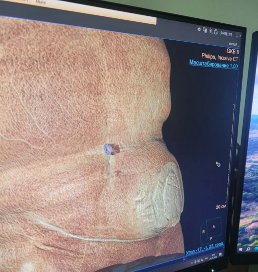 Воронежцу удалили грыжу размером с дыню