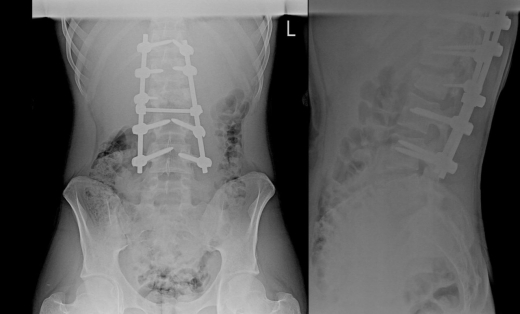 «Не мог пошевелить ногами»: воронежские медики поставили на ноги подростка, на которого упало бревно