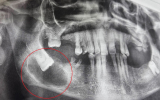 Неприятный сюрприз в челюсти пенсионера обнаружили воронежские стоматологи