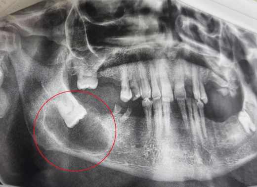Неприятный сюрприз в челюсти пенсионера обнаружили воронежские стоматологи
