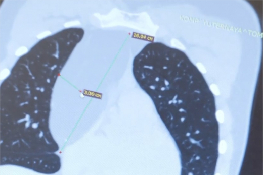 Московские врачи удалили подростку крупную опухоль, давящую на сердце