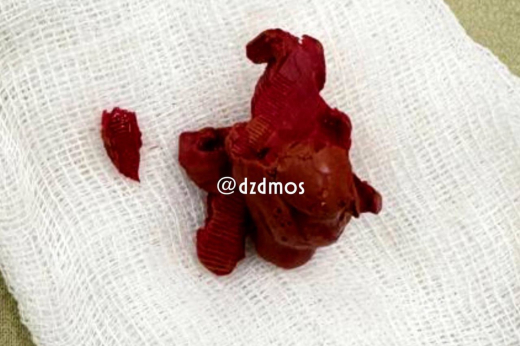 В Москве пластилин размером с киви нашли у школьника в мочевом пузыре