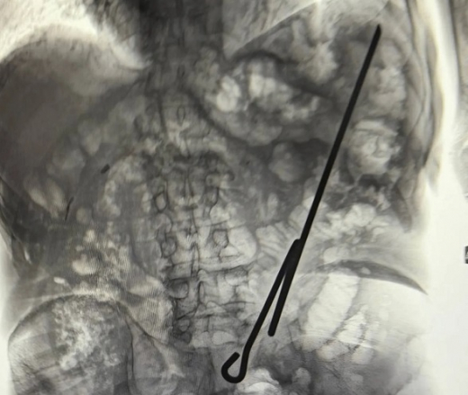 Самодельный инструмент и червя вытащили из воронежцев хирурги