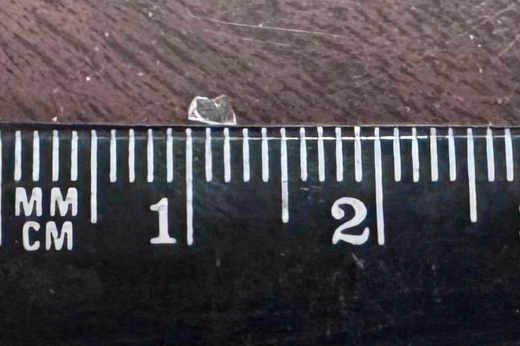 В Раменском мужчина после атаки дрона 1,5 года проходил с осколком в глазу