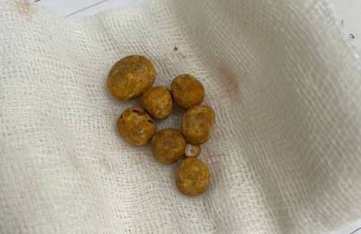 Воронежский пенсионер чуть не погубил себя травами, пытаясь вылечить желчнокаменную болезнь