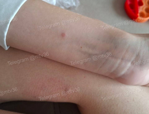 Пострадавшая от бездомной собаки воронежская школьница получит 25 тыс. рублей