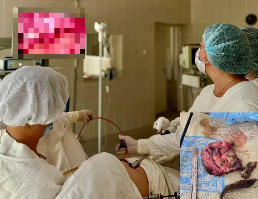 12-сантиметровую опухоль с волосами удалили женщине в воронежской больнице