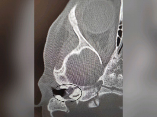 Двухлетняя девочка из Воронежа едва не лишилась слуха после ОРВИ