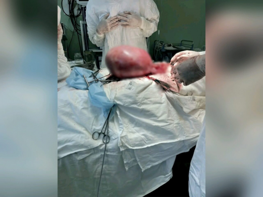Живот был как на 28-й неделе беременности: воронежские врачи удалили пациентке гигантскую миому