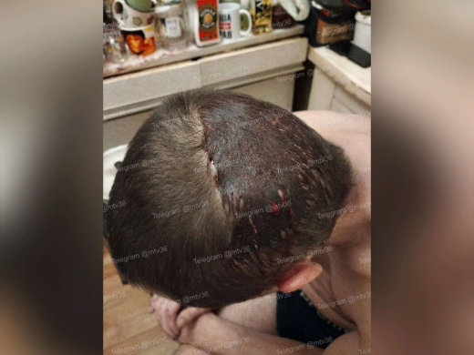 Подростки проломили воронежцу голову ради шутки