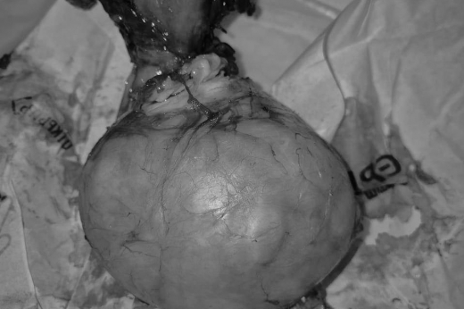 64-летней жительнице Подмосковья удалили миому размером с волейбольный мяч