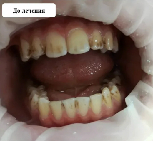 У воронежского школьника почернели зубы из-за колы и крепкого чая