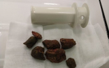 9-сантиметровые камни достали воронежские врачи из желудка пациента
