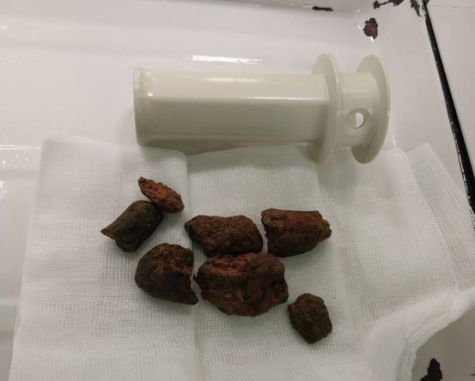 9-сантиметровые камни достали воронежские врачи из желудка пациента