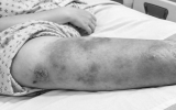 Две девочки попали в больницу в Подмосковье из-за мозолей и ссадин