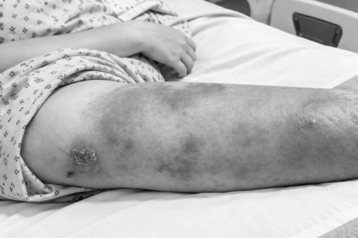 Две девочки попали в больницу в Подмосковье из-за мозолей и ссадин