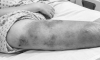 Две девочки попали в больницу в Подмосковье из-за мозолей и ссадин