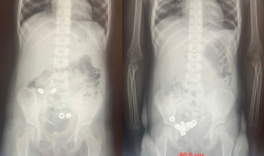 Трёхлетний малыш из Воронежа проглотил 16 гаек и попал в больницу